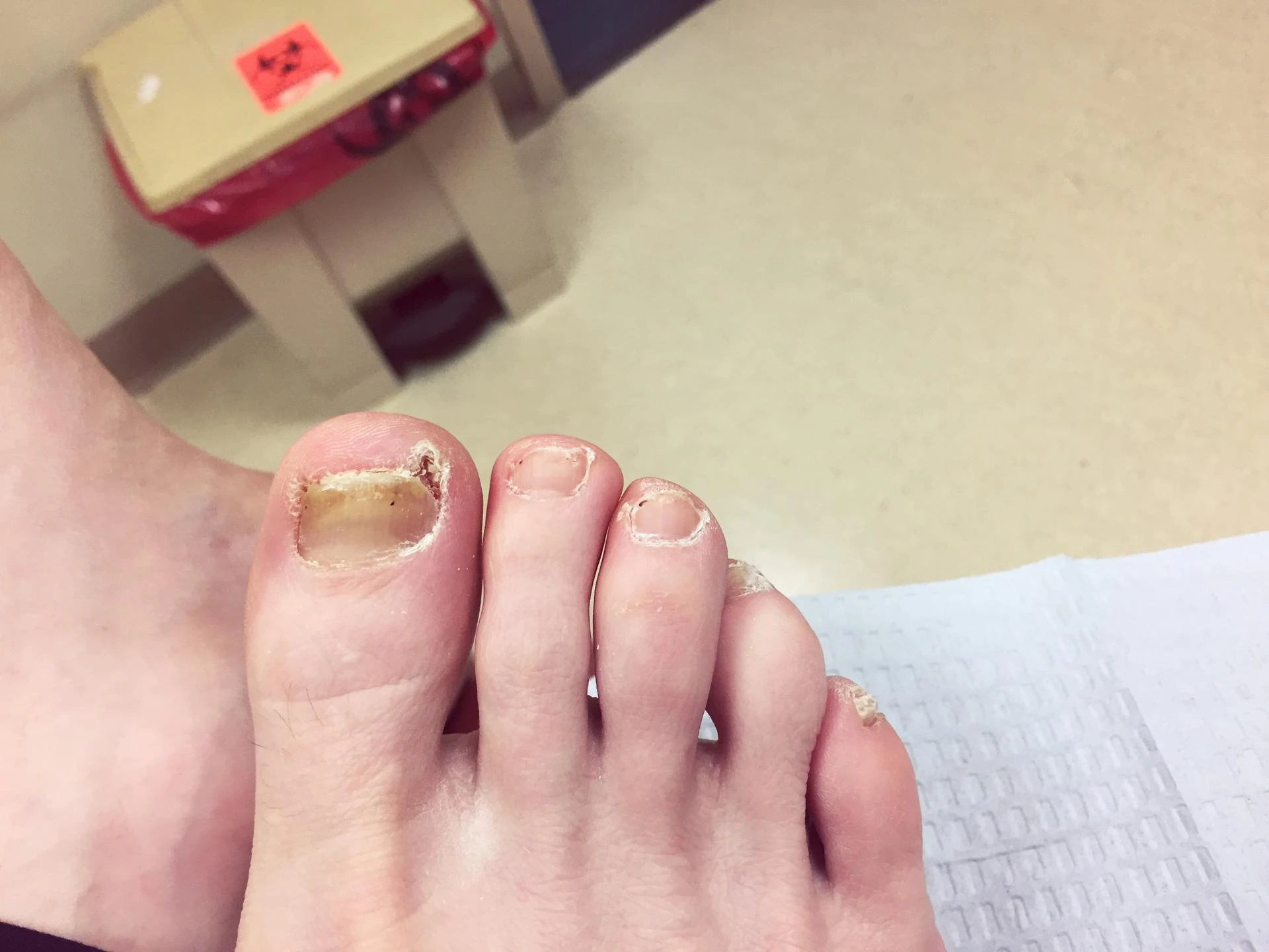 Nail Dystrophy